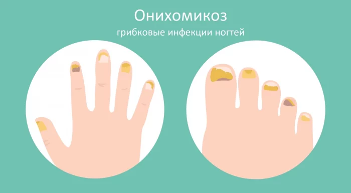 Эффективные способы борьбы с грибком ногтей в домашних условиях